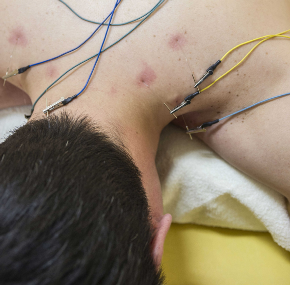 Valg af nåle ved akupunktur med el-stimulation